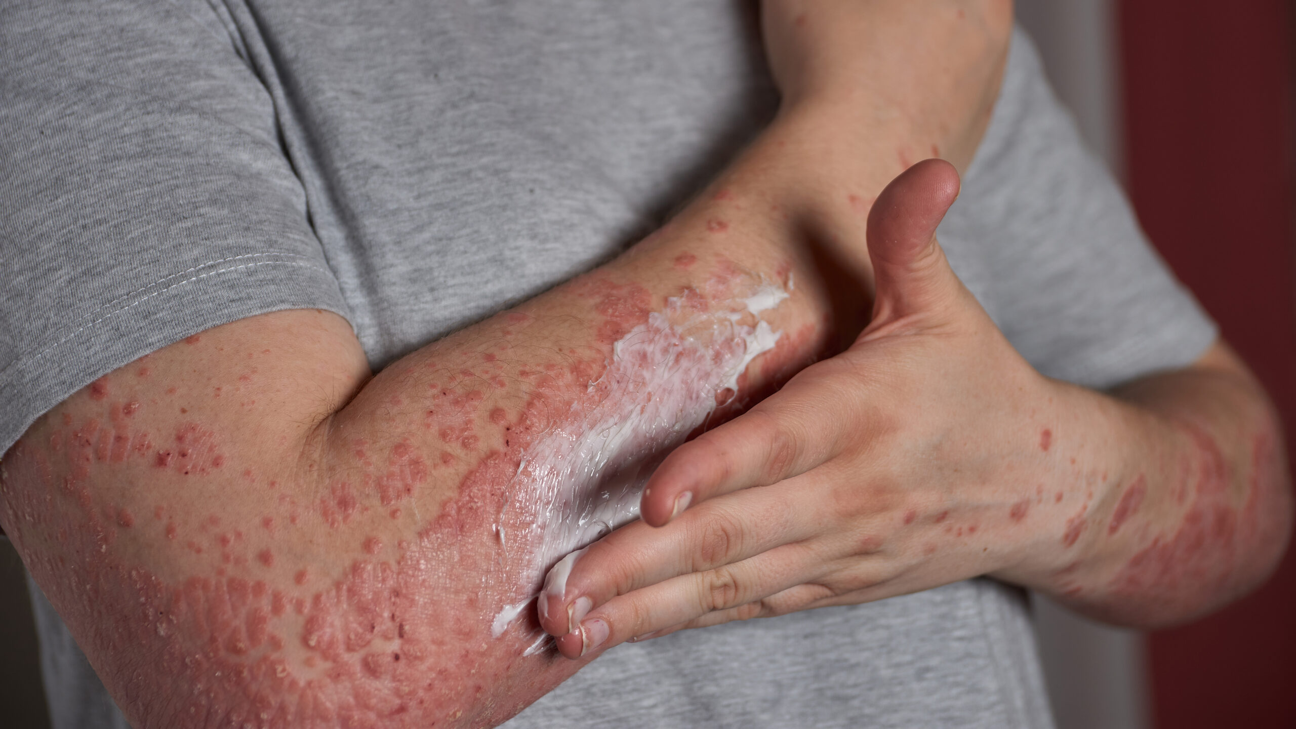 Atopic-Dermatitis_Gallery-3_Home